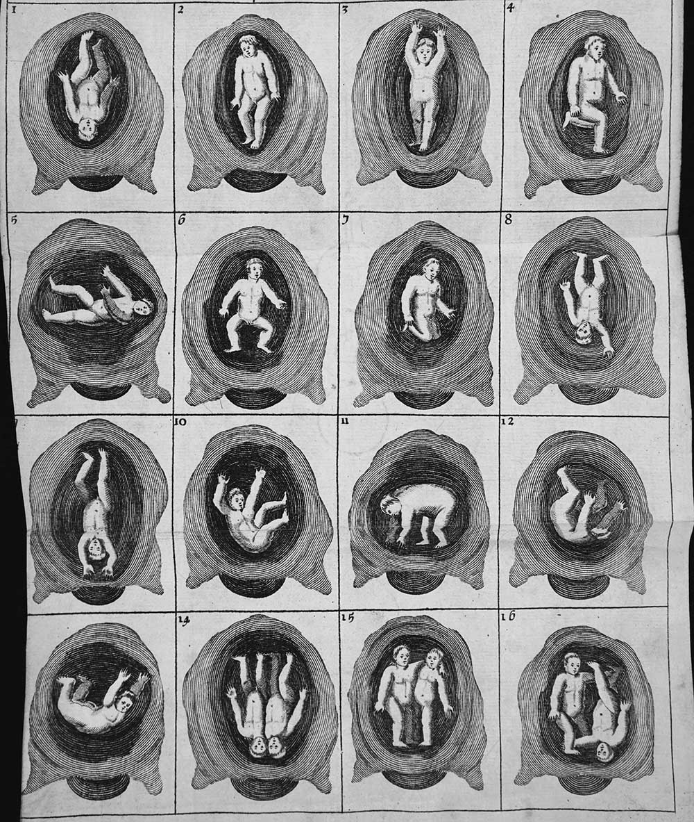 The Figure of the Child Turning Itself to the Birth, from James Cooke’s Mellificium Chirurgiae: Or, the Marrow of Chirurgery Much Enlarged, 1693.