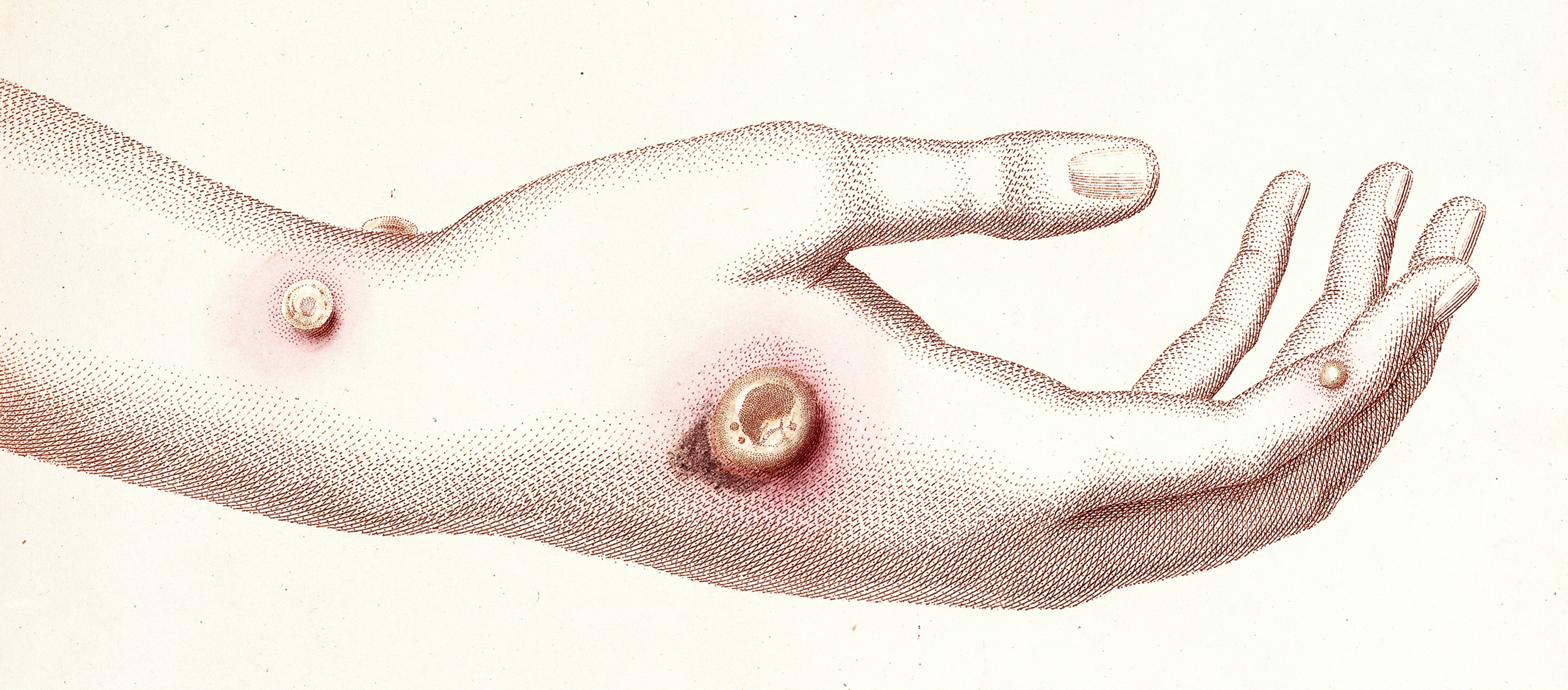 Hand with boils, from An Inquiry into the Causes and Effects of the Variolae Vaccinae, by Edward Jenner, 1798. The Wellcome Library, London. 