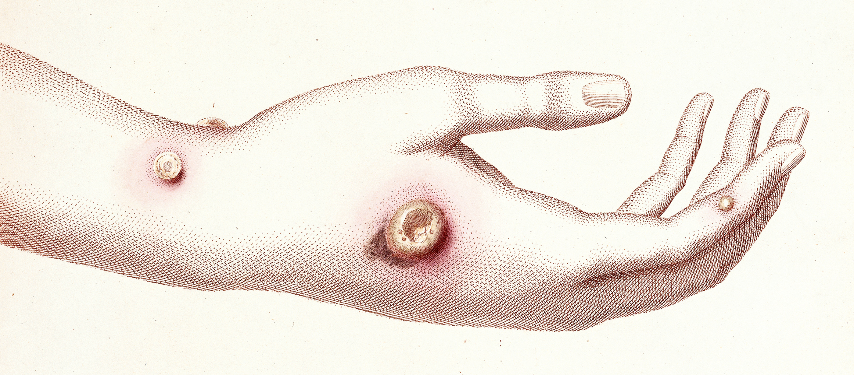 Hand with boils, from An Inquiry into the Causes and Effects of the Variolae Vaccinae, by Edward Jenner, 1798. The Wellcome Library, London.