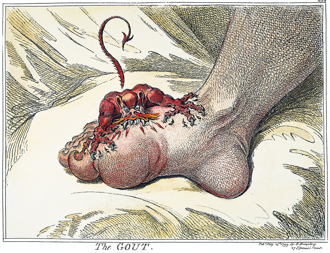 The Gout, etching by James Gillray, 1799.