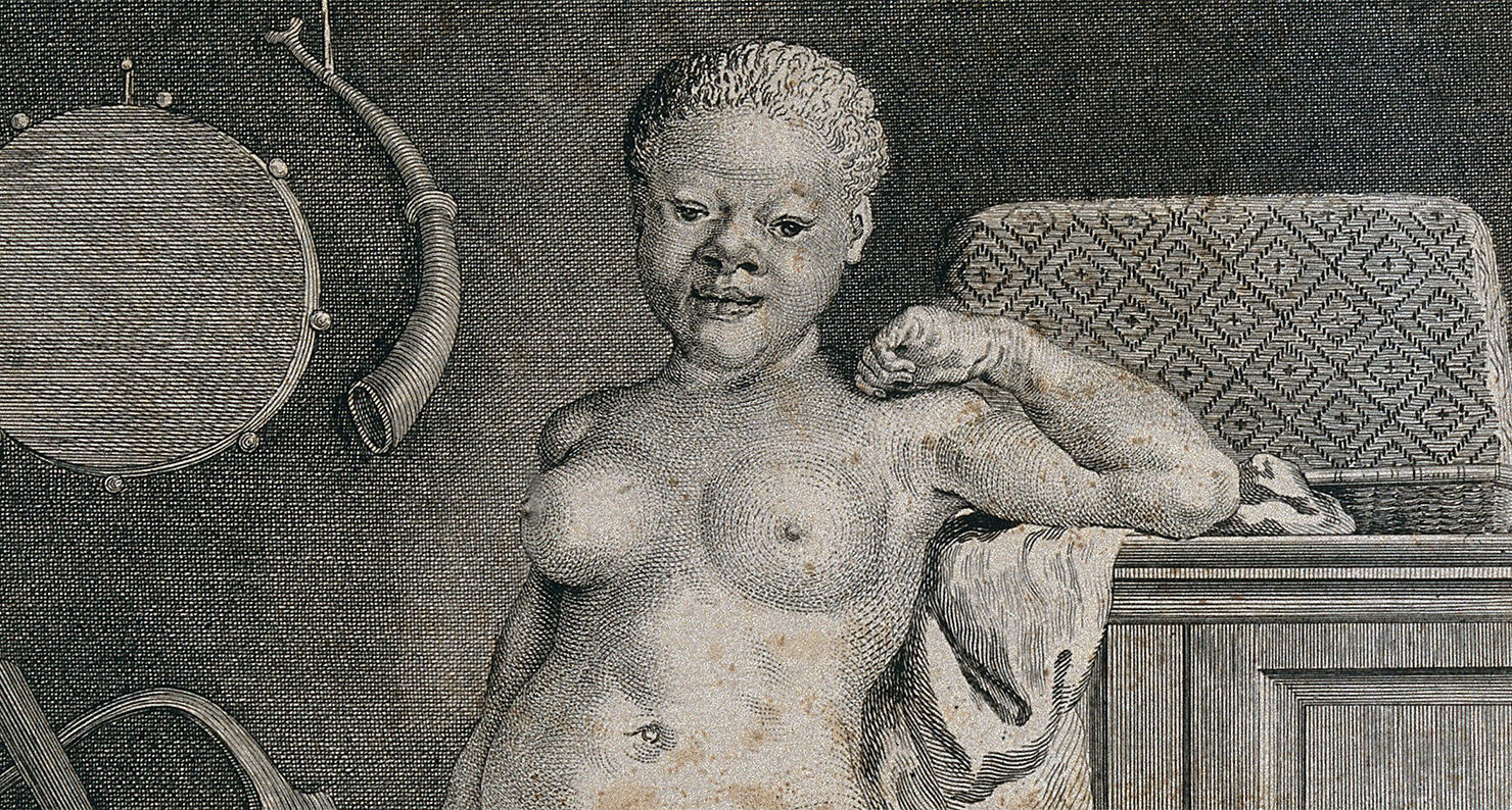 An albino negress, engraving by C. Guttenberg after Jacques de Sève, 1777.