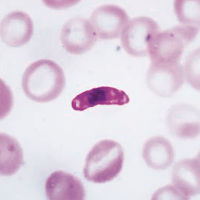Malaria under a microscope
